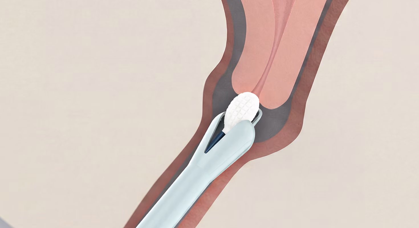 Diagram: how the Teal Wand collects a vaginal sample